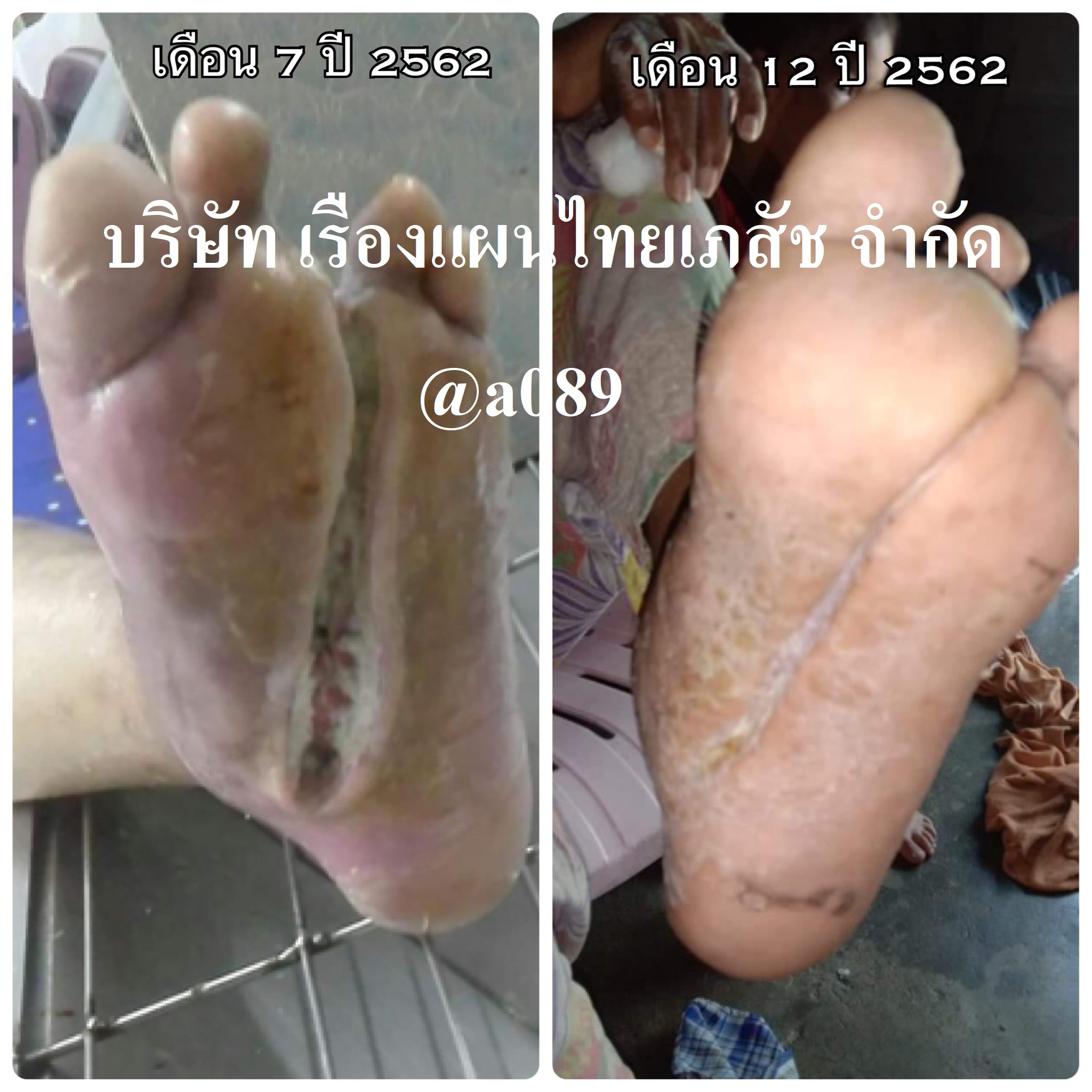 แผลเบาหวาน